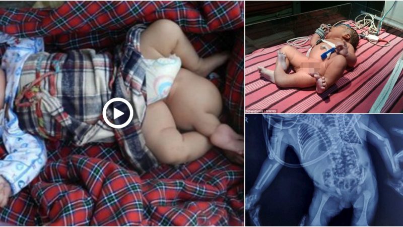 Parents abandon newborn baby after discovering third leg.