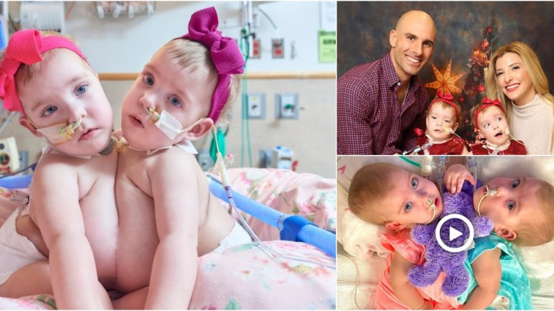 Unbreakable Bond: The Inspiring Story of Separating Conjoined Twins Lily and Addy Altobelli