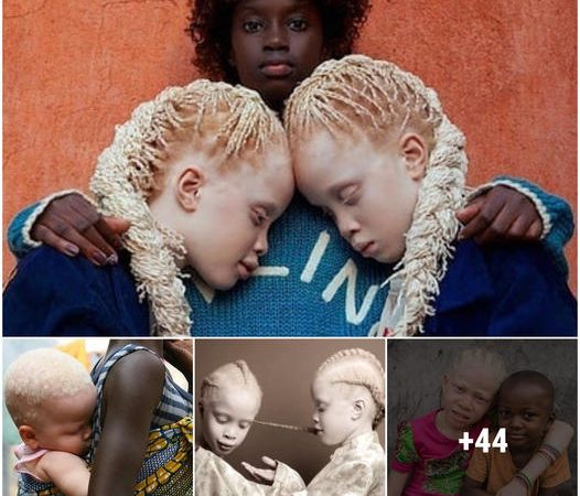 Unbelievable Tale: The Albino Twins who Conquered the World