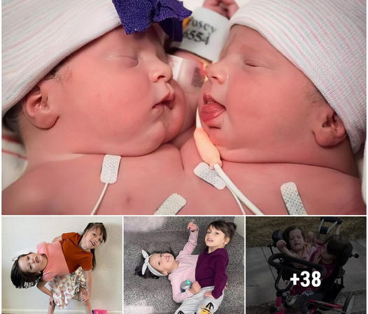 Embracing the Extraordinary: Conjoined Twins Emma and Olivia Embark on their Educational and Life Journey