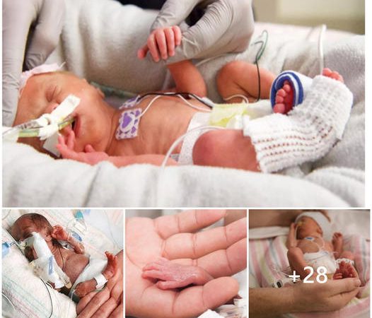 Newborn Baby Breaks Records as World’s Smallest, Measuring 8.2 Inches and Weighing 230 Grams