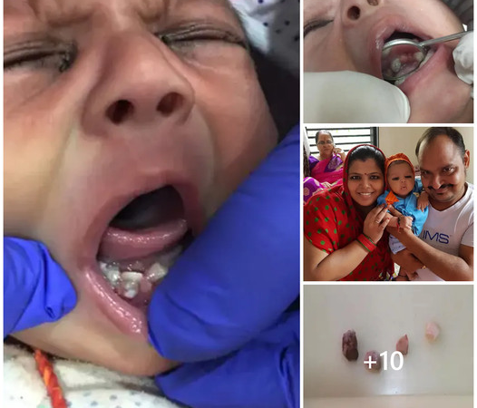 A Unique Arrival: Baby Born With Seven Teeth Surprises Medical Community