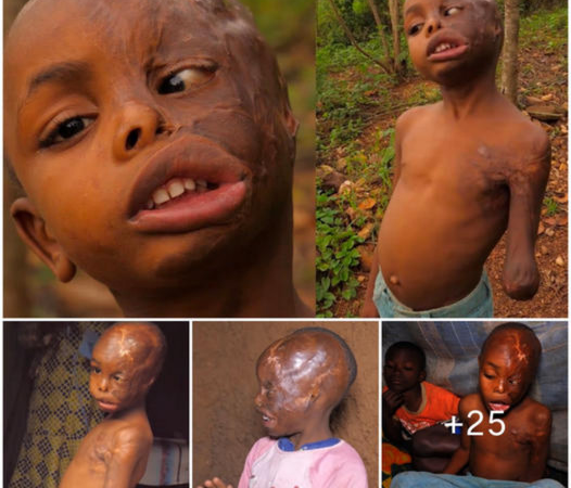 The Resilient Journey of a Child Overcoming 80% Burns