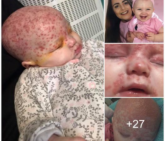 Mother Issues Warning After Six-Month-Old Baby Contracts Herpes Despite Kissing Ban