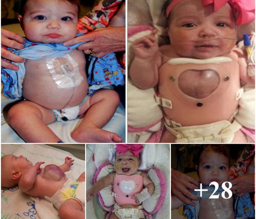 A Journey of Triumph: Baby Born with Heart Outside the Body