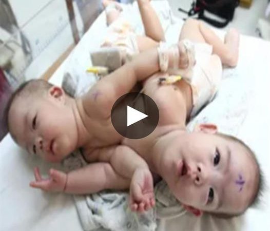 A Miraculous Separation: Conjoined Twins Triumph Over Adversity